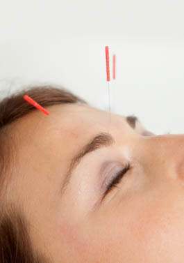 Is Treating Insomnia with Acupuncture the Ideal Natural Solution?